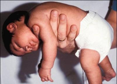 دلیل و درمان شلی عضلات در نوزادان چیست؟
